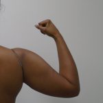 Arm Liposuction Before & After Patient #1075