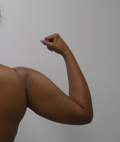 Arm Liposuction Before & After Patient #1075