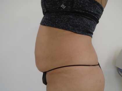Lipo 360 Before & After Patient #1045