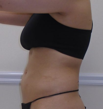 Lipo 360 Before & After Patient #1052