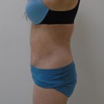 Lipo 360 Before & After Patient #1059