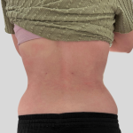 Lipo 360 Before & After Patient #1068