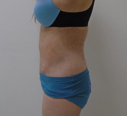 Lipo 360 Before & After Patient #1059