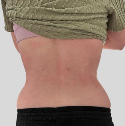 Lipo 360 Before & After Patient #1068