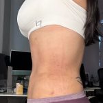 Lipo 360 Before & After Patient #1052