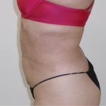 Lipo 360 Before & After Patient #1045