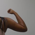 Arm Liposuction Before & After Patient #1075