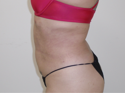 Lipo 360 Before & After Patient #1045