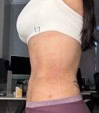 Lipo 360 Before & After Patient #1052
