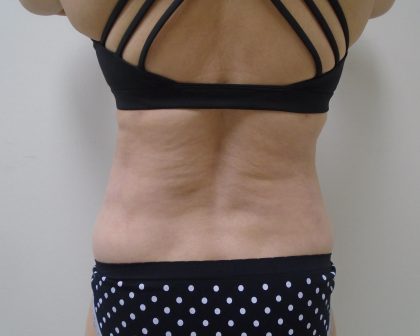 Lipo 360 Before & After Patient #1059