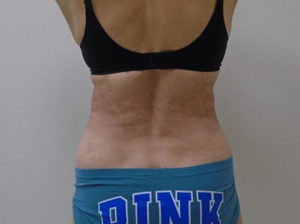 Lipo 360 Before & After Patient #1059