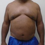 ULF Before & After Patient #1135