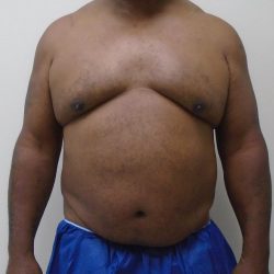 ULF Before & After Patient #1135