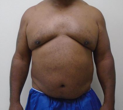 ULF Before & After Patient #1135