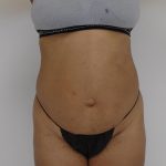 Lipo 360 Before & After Patient #565