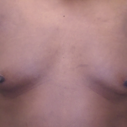 Gynecomastia Before & After Patient #1142