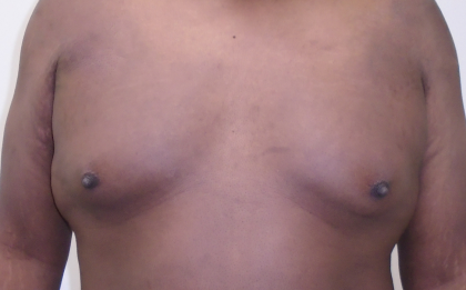 Gynecomastia Before & After Patient #1142