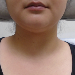 Chin Before & After Patient #1145