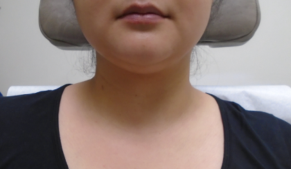 Chin Before & After Patient #1145