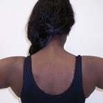 Arm Liposuction Before & After Patient #1139