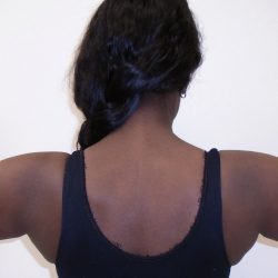 Arm Liposuction Before & After Patient #1139