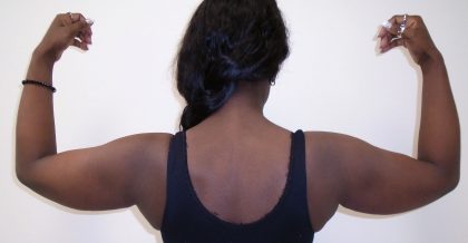 Arm Liposuction Before & After Patient #1139
