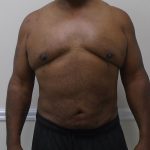 ULF Before & After Patient #1135