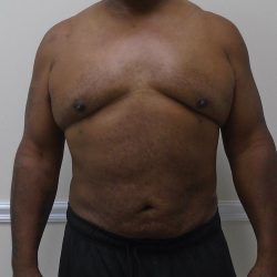 ULF Before & After Patient #1135