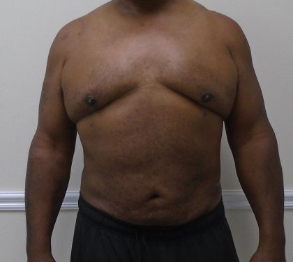 ULF Before & After Patient #1135