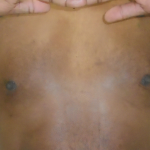 Gynecomastia Before & After Patient #1142