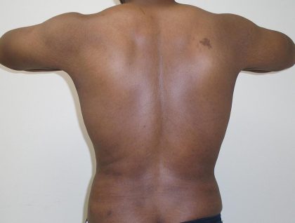 ULF Before & After Patient #1177