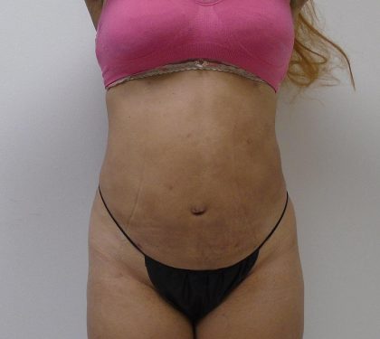 Lipo 360 Before & After Patient #565