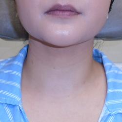 Chin Before & After Patient #1145