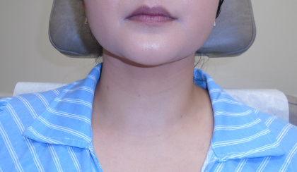 Chin Before & After Patient #1145
