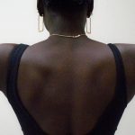 Arm Liposuction Before & After Patient #1139