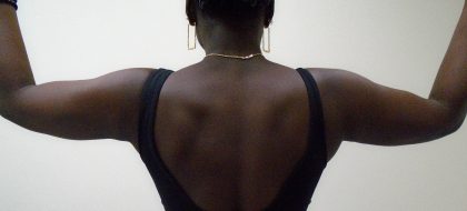 Arm Liposuction Before & After Patient #1139