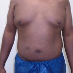 ULF Before & After Patient #1177