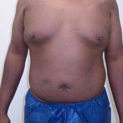 ULF Before & After Patient #1177