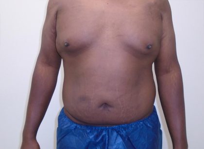 ULF Before & After Patient #1177