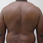 ULF Before & After Patient #1135