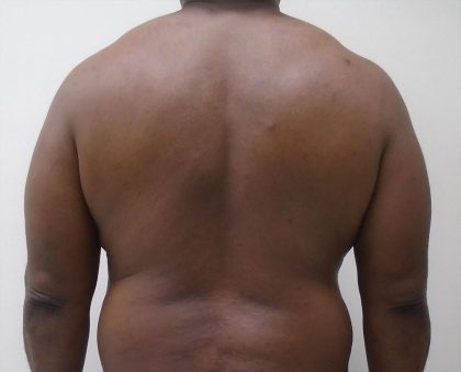ULF Before & After Patient #1135