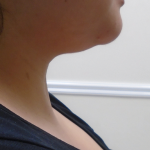 Chin Before & After Patient #1145