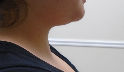 Chin Before & After Patient #1145