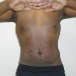 ULF Before & After Patient #1177