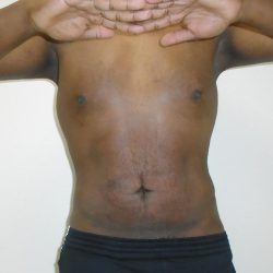 ULF Before & After Patient #1177