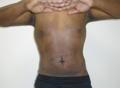 ULF Before & After Patient #1177