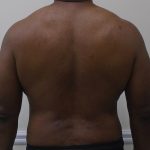 ULF Before & After Patient #1135