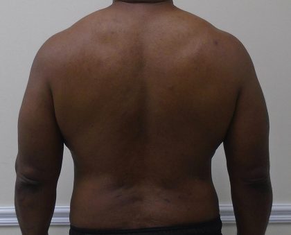 ULF Before & After Patient #1135