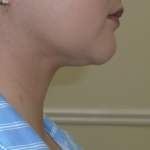 Chin Before & After Patient #1145