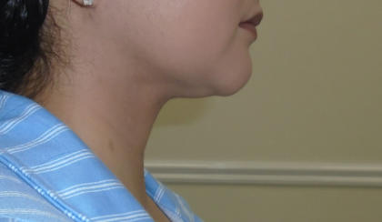 Chin Before & After Patient #1145